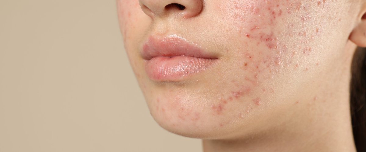 wp-content/uploads/2026/05/10-beste-Korean-skincare-producten-tegen-acne.png