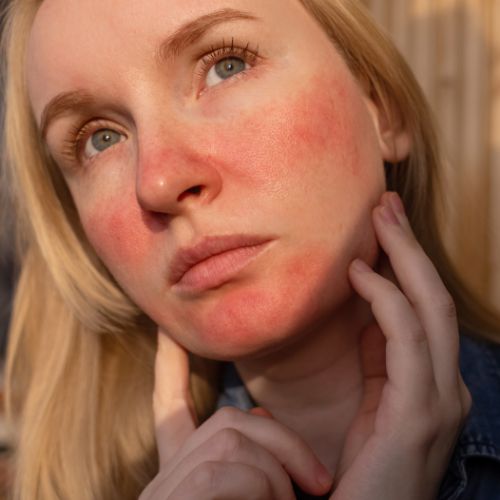 Rosacea op de huid