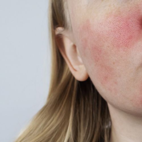 Rosacea op de wang