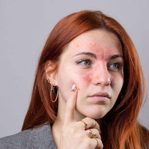 Rosacea voorhoofd neus wang