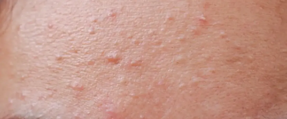 wp-content/uploads/2025/08/Fungal-acne-foto.webp
