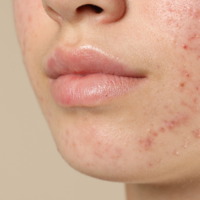 10 beste Korean skincare producten tegen acne